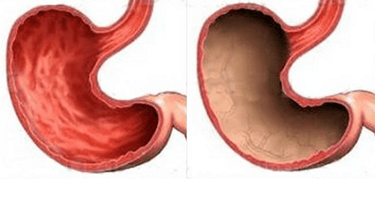 Ulcer, gastritis, cancer, and other pathologies of the stomach (on the right), the appearance of which was caused by alcohol
